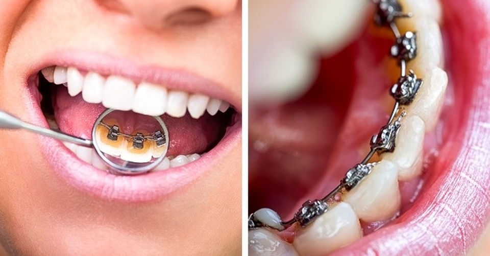 8 sai lầm phổ biến khi chăm sóc răng - 6 8 sai lầm phổ biến khi chăm sóc răng - 6