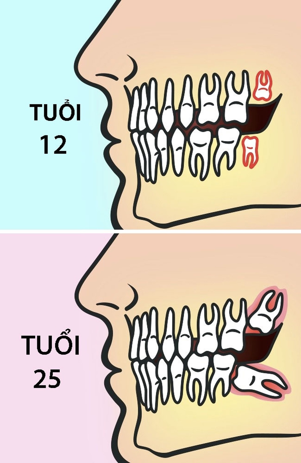 Vì sao nên nhổ răng khôn trước 25 tuổi? - 1 Vì sao nên nhổ răng khôn trước 25 tuổi? - 1