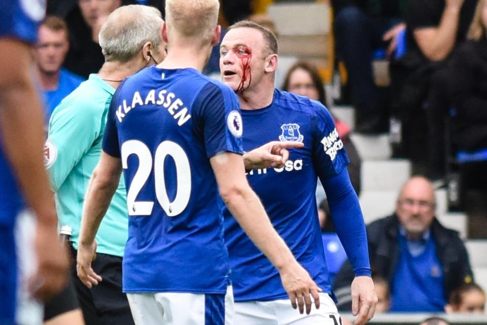 Lĩnh trọn cùi chỏ, Rooney máu chảy đầm đìa - 1 Wayne Rooney chảy máu đầm đìa sau khi lĩnh trọn cú thúc cùi chỏ của Simon Francis