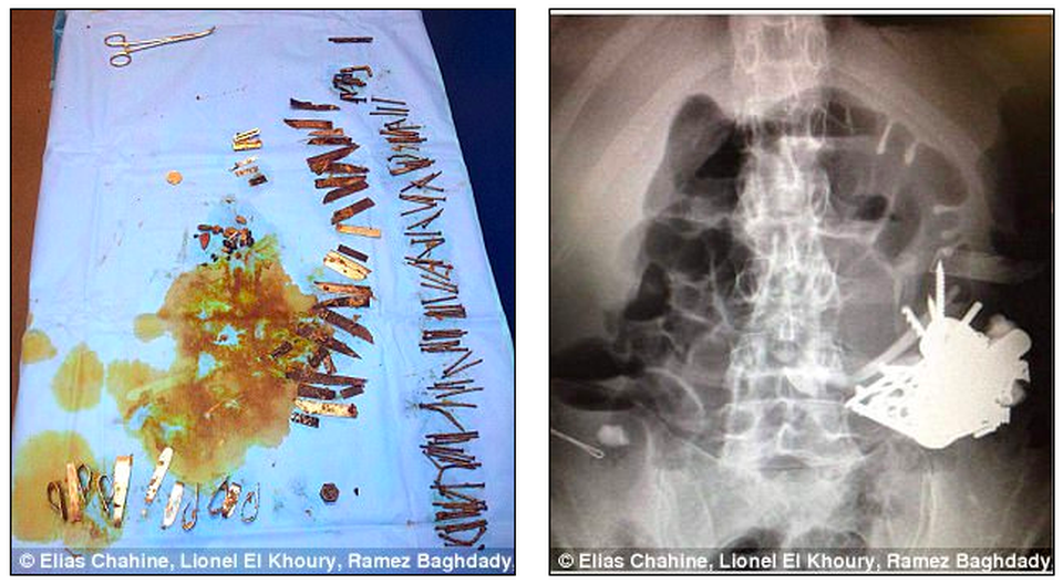 Bệnh nhân liên tục nuốt hơn 100 mảnh kim loại trong 10 năm - 1 Người đàn ông 52 tuổi (ở Pháp) mắc chứng tâm thần, thường xuyên nuốt các vật sắc nhọn mà không thể tiêu hóa được.