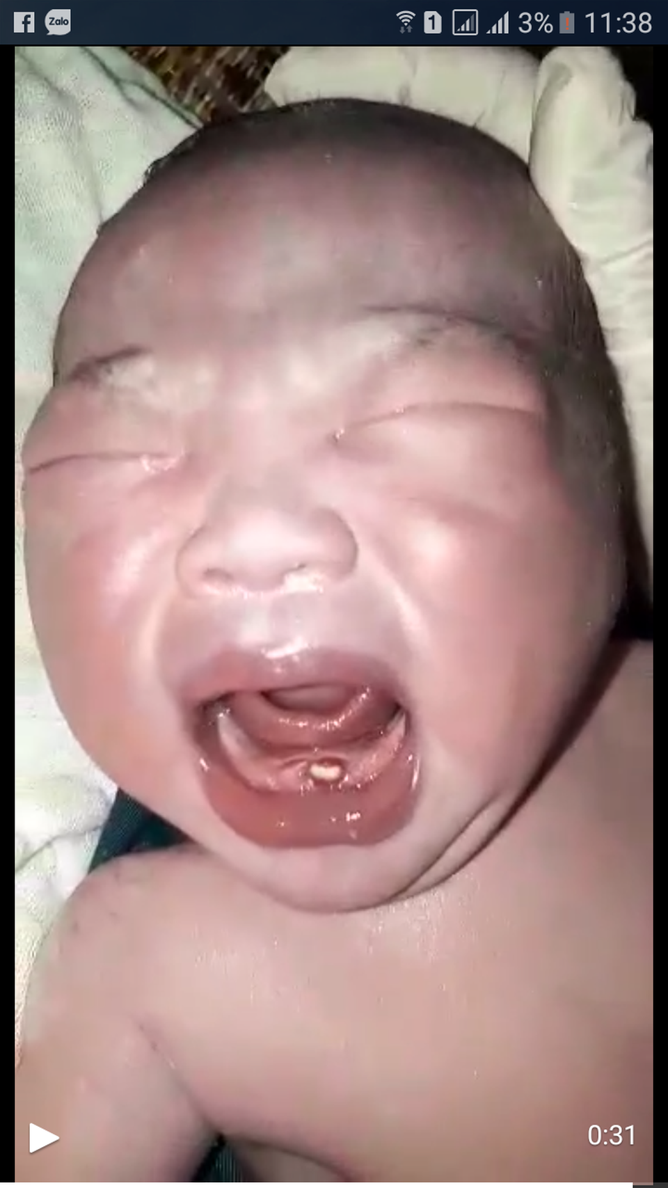 Bé trai vừa chào đời đã mọc răng - 1 Bé trai vừa chào đời đã mọc một chiếc răng sữa tại bệnh viện Đa khoa huyện Hương Khê