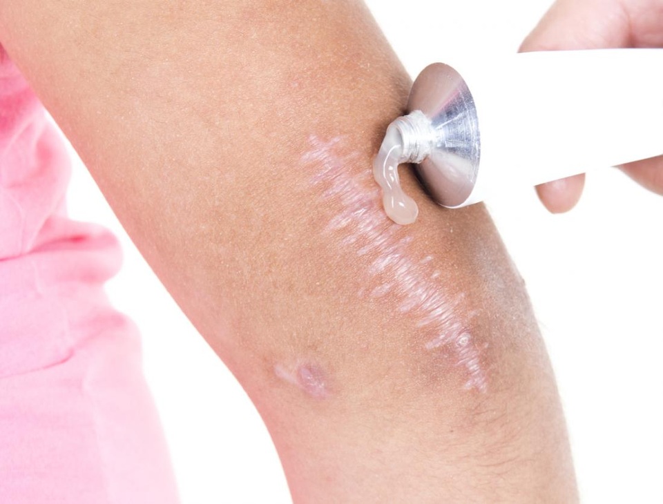 Các biện pháp xóa sẹo tại nhà - 2
Dán miếng silicon hoặc bôi gel silicon lên da có thể giúp cải thiện sẹo.