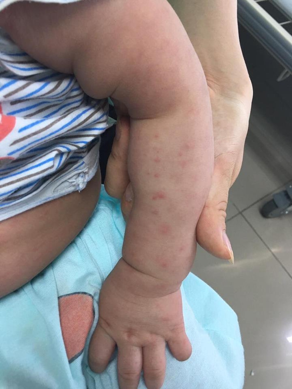 Làm gì khi bị sốt giữa mùa dịch sốt xuất huyết? - 2
Xuất huyết dưới da - biểu hiện điển hình của sốt xuất huyết ở ngày thứ 3-4