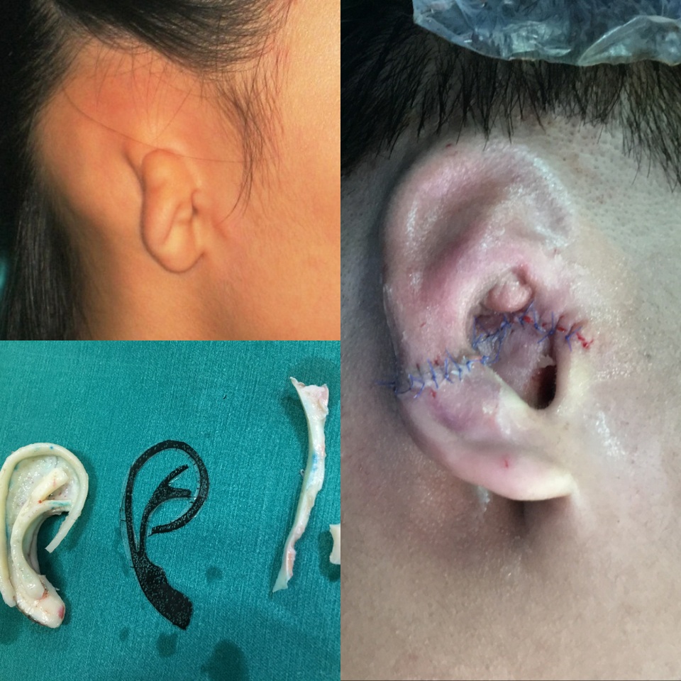 Cậu bé 8 tuổi nuôi tóc dài như con gái che vành tai khiếm khuyết bẩm sinh - 1 Hình ảnh tai khiếm khuyết bẩm sinh và lành lặn sau khi được tạo hình. Ảnh: BS cung cấp.