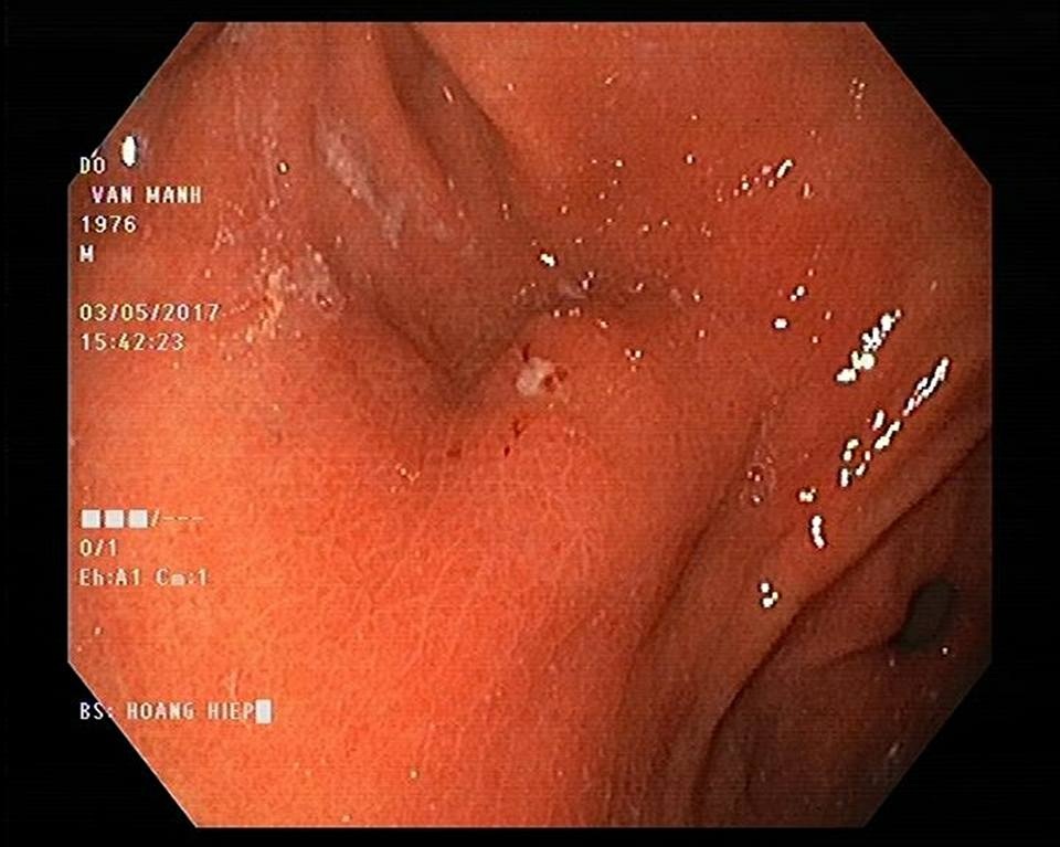 Tưởng đau dạ dày hoá tăm nhọn “ngự” lâu năm không biết - 2 Tăm nhọn đâm làm trợt vùng thành dạ dày. Ảnh: BS cung cấp.