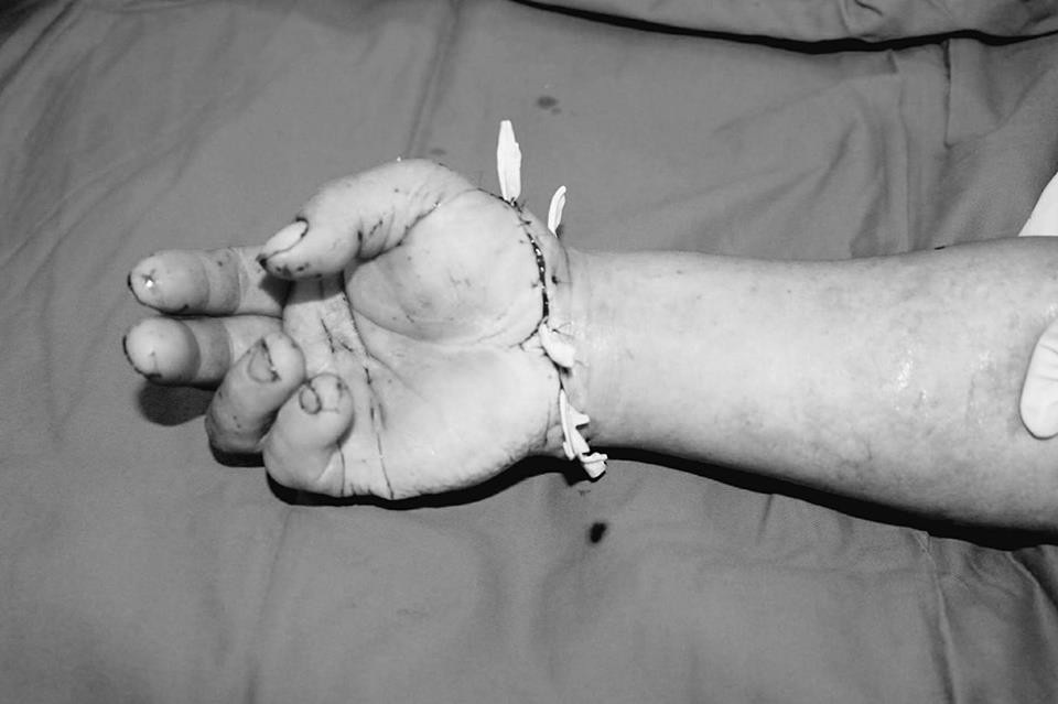 10 giờ phẫu thuật cứu bàn tay đứt rời khỏi cơ thể người bệnh - 1 Bàn tay được nối liền đã có dấu hiệu sống trở lại. Ảnh: BS cung cấp.