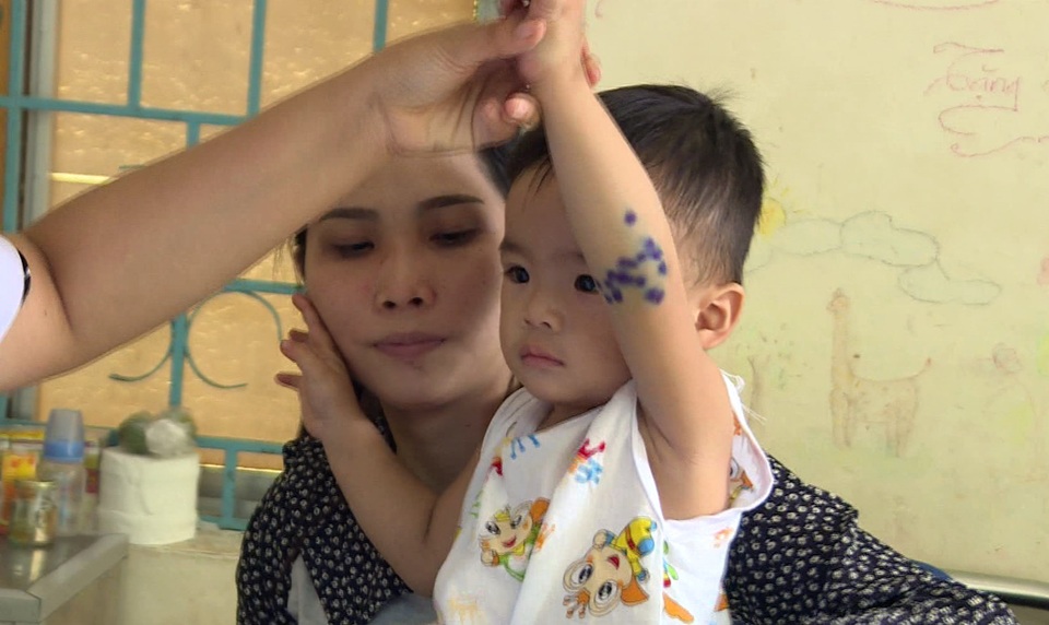 Dấu hiệu nhận biết bệnh là sốt, đau họng, tổn thương niêm mạc miệng và da ở dạng phỏng nước, tập trung ở lòng bàn tay, bàn chân, đầu gối và mông