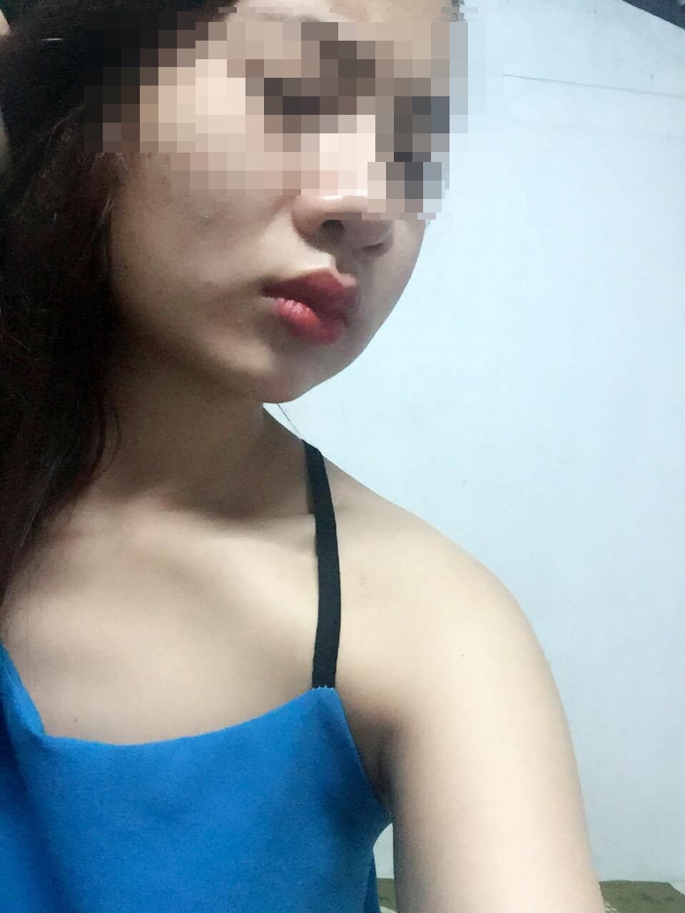 Mặt sưng phù vì làm má lúm đồng tiền tại nhà - 1
Chị A. bị tổn thương khuôn mặt do làm đẹp tại nhà