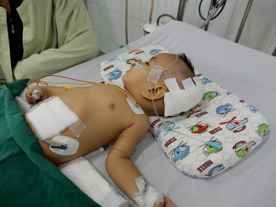 Thương cháu bé 11 tháng tuổi bị não úng thủy - 2 Cháu đã được phẫu thuật dẫn lưu não thất - ổ bụng