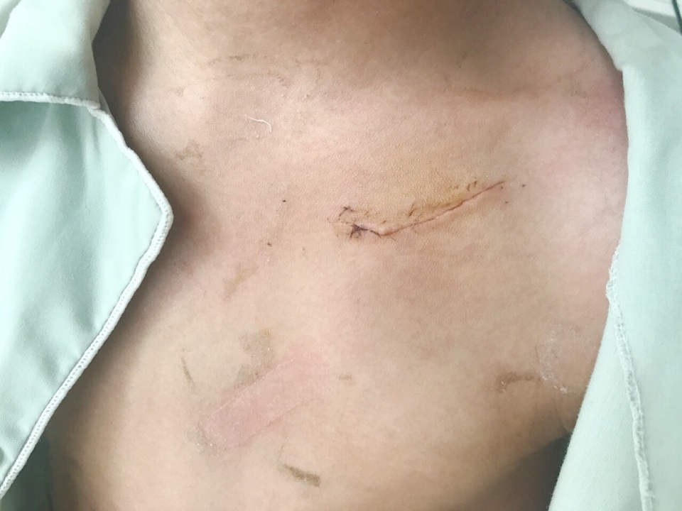 Cháu bé bị hội chứng Brugada dễ đột tử ban đêm được cấy máy đem lại sự sống - 2 Vết mổ khô sau 1 tuần cấy máy, không thấy lộ máy đảm bảo thẩm mỹ và giảm nguy cơ nhiễm trùng lộ máy