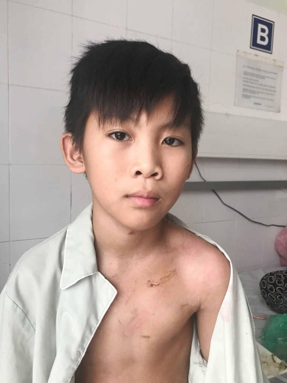 Cháu bé bị hội chứng Brugada dễ đột tử ban đêm được cấy máy đem lại sự sống - 1 Em Thiện sau khi được cấy máy phá rung tự động ICD thành công