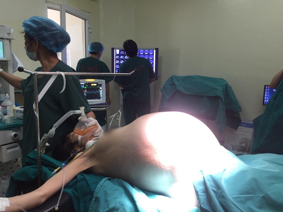 Bệnh nhân như mang bầu song sinh vì khối u 16kg trong bụng - 1 Khối u khủng chèn ép khiến bệnh nhân suy kiệt, khó thở, không ăn uống được. Ảnh: BS cung cấp.
