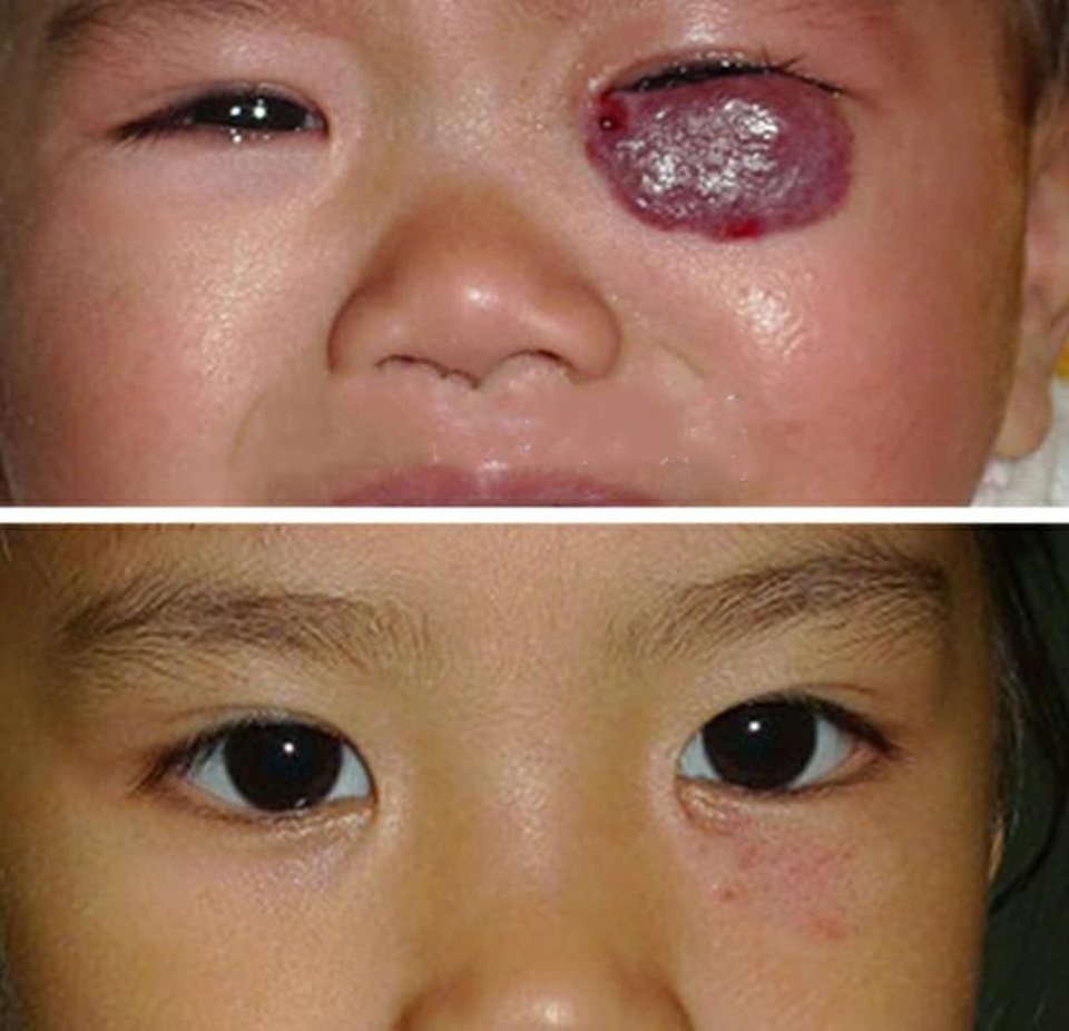 Điều trị các bất thường về mạch máu như thế nào? - 2 Bệnh nhi u máu trước và sau khi được BS Nghị điều trị.