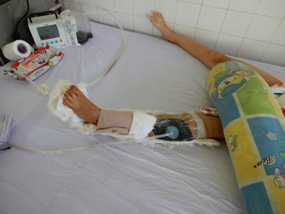 Bị tai nạn giao thông, bố và con gái 7 tuổi có nguy cơ mất chân - 4 Hiện cả chân của anh Khánh và cháu Ly đều khó bảo tồn