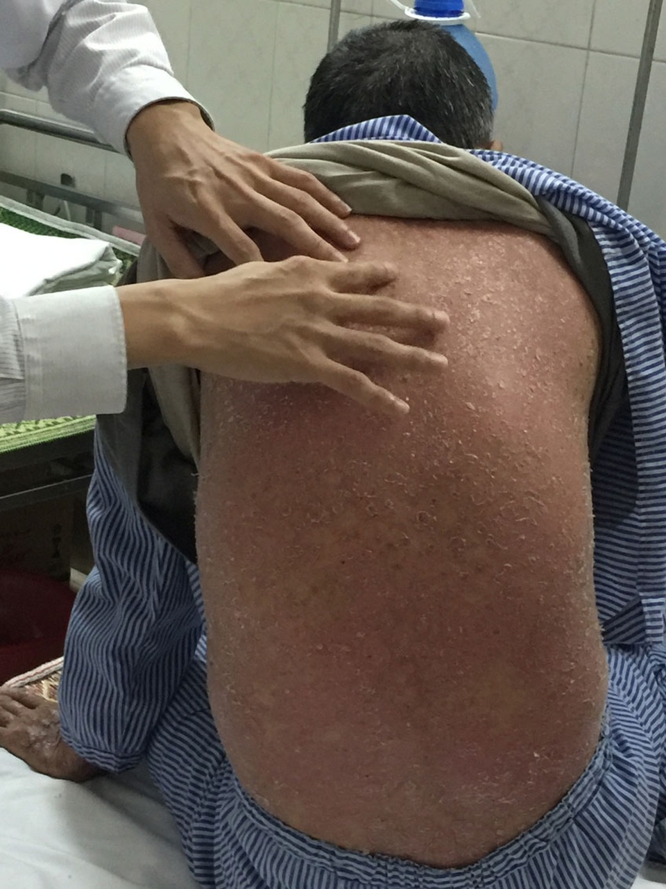 5 thách thức hàng triệu người mắc vảy nến đang phải đối mặt - 1
Bệnh nhân bị sốt, bong tróc da toàn thân sau khi uống 6 thìa thuốc đông y (Ảnh: T.P)