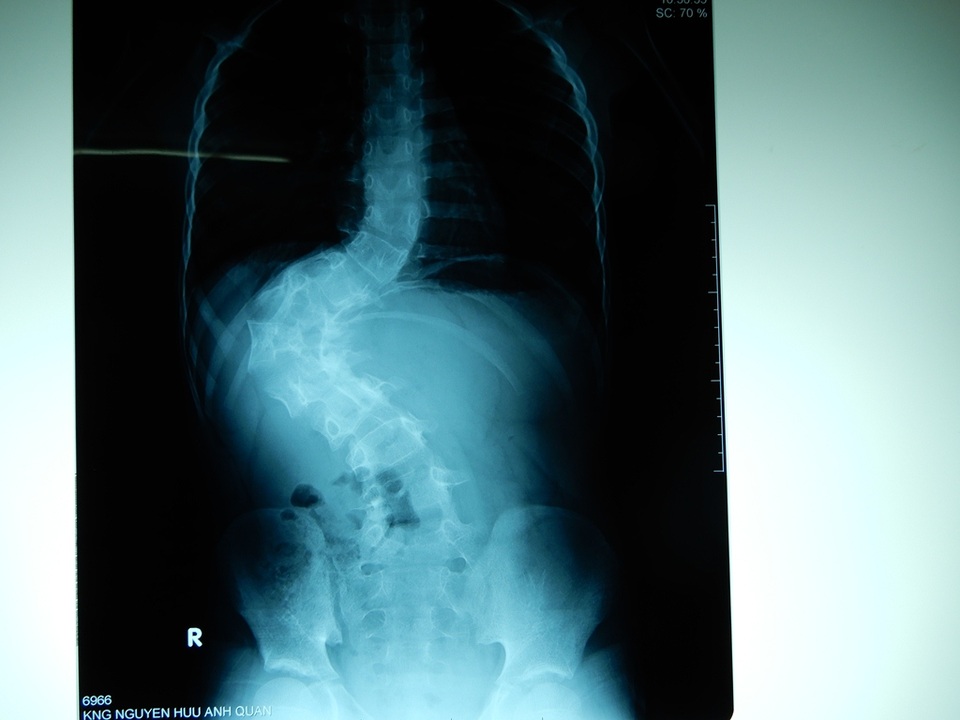 Cháu Anh Quân đã được phẫu thuật cột sống - 1 Phim chụp cột sống cháu Quân trước phẫu thuật