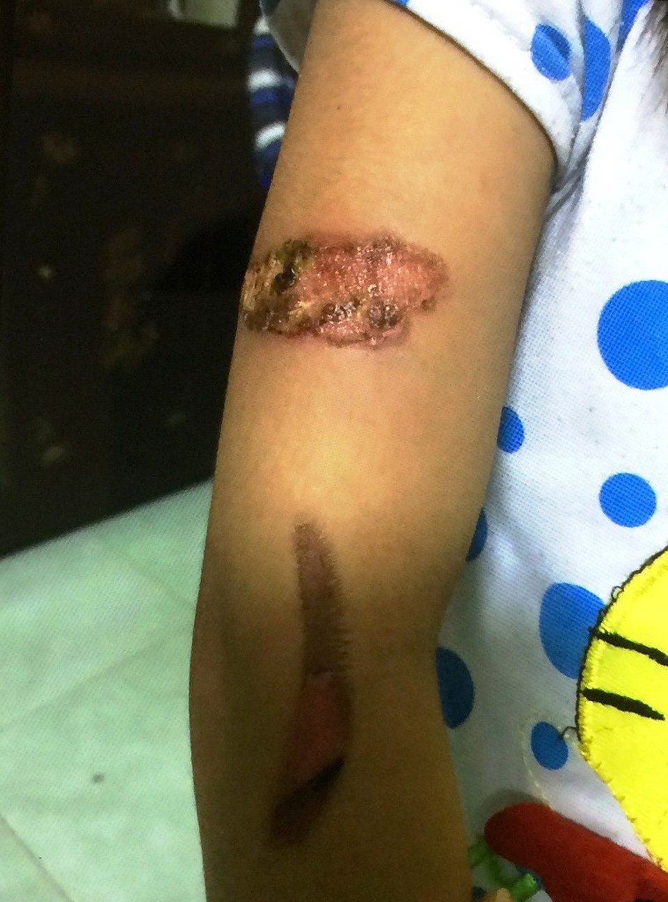 Cháu bé 7 tuổi nghi bị dí sắt đỏ vào người về sống cùng bà nội - 1 Các vết thương trên người cháu T. không cùng một vị trí nên dư luận cho rằng lời giải thích của cha ruột và mẹ kết cháu T. là không chấp nhận được