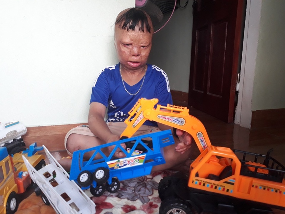 Ước mơ làm lính cứu hỏa của cậu bé bị cha tẩm xăng đốt - 1
Cháu Vũ Quốc Linh với những vết sẹo không thể biến mất
