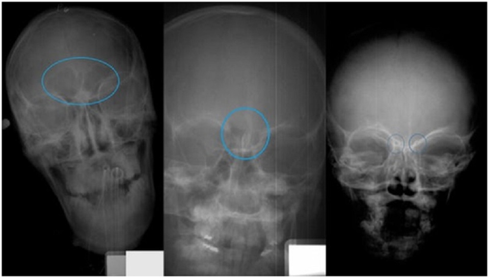 Phương pháp chụp X-quang xoang trán tiết lộ số tuổi của trẻ - 1