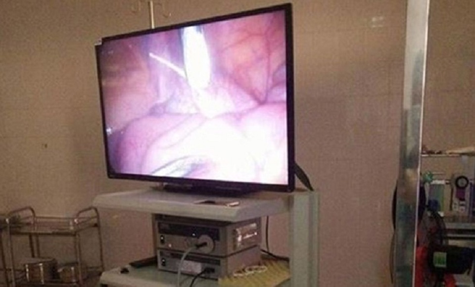 Qua nội soi, các bác sĩ phát hiện ruột non của bệnh nhân bị một đoạn xương cá dài khoảng 2 cm đâm thủng.