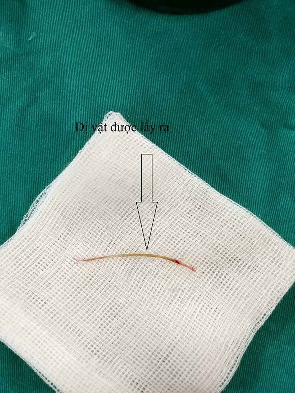 Chiếc xương cá là nguyên nhân khiến bệnh nhân đau bụng cả tuần nay. Ảnh: BS cung cấp.