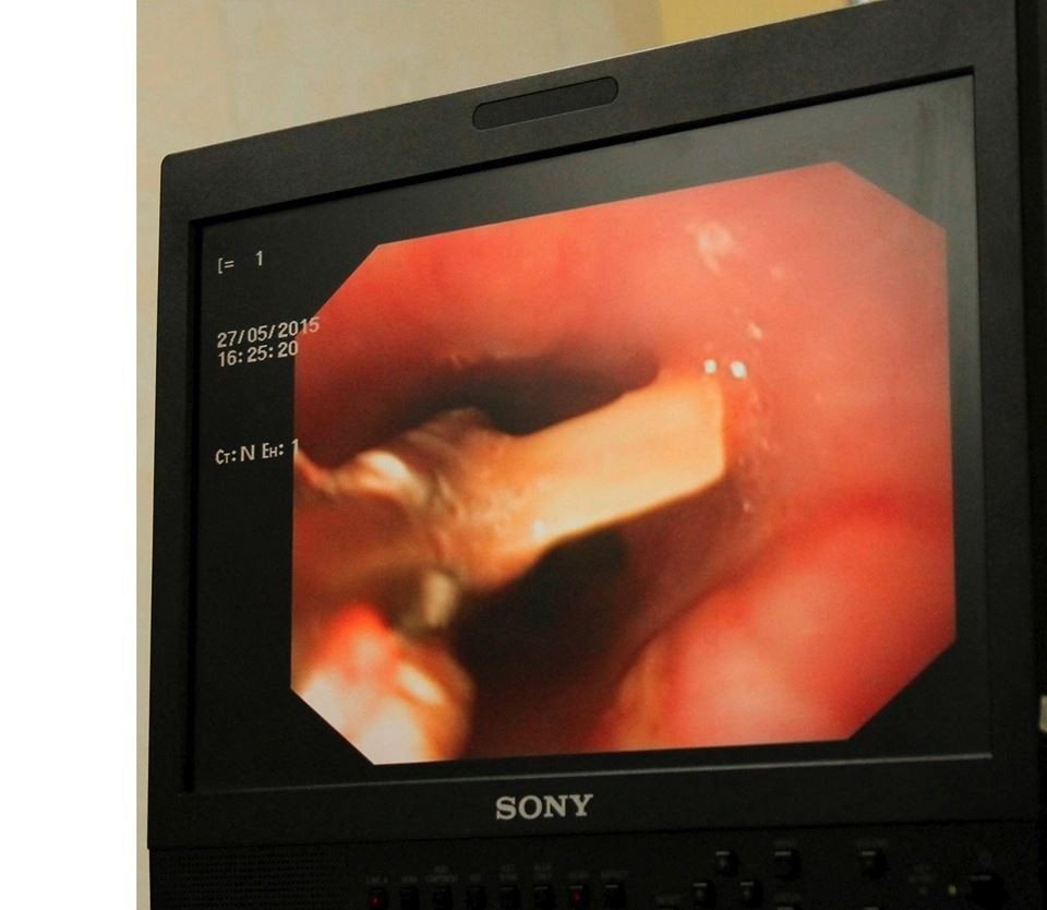 Xương gà chắn ngang thực quản nữ bệnh nhân, đe dọa tính mạng - 1 Hình ảnh xương gà đâm sâu vào thực quản. Ảnh: BS cung cấp.