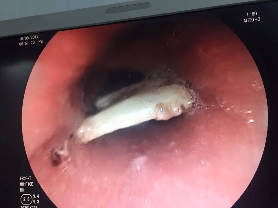 Xương lợn dài 2,5cm chắn ngang thực quản bệnh nhân - 1 Miếng xương lợn dài 2,5cm, sắc nhọn rơi vào thực quản khiến bệnh nhân đau tức ngực dữ dội. Ảnh: BS cung cấp.