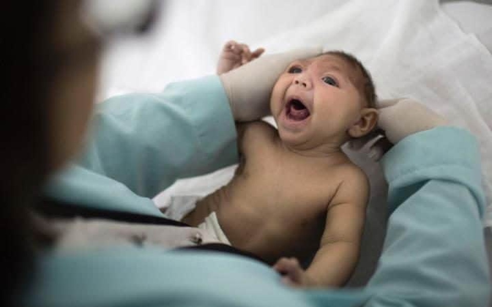 Vi rút Zika có thể là chìa khoá để chống lại khối u não? - 1 Một em bé bị tật đầu nhỏ ở Brazil