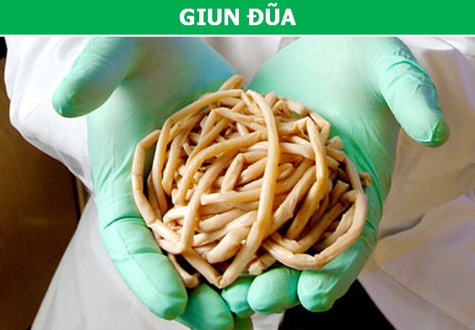 “Rùng mình” với những loài giun sán ký sinh nguy hiểm nhất trên trái đất - 4 “Rùng mình” với những loài giun sán ký sinh nguy hiểm nhất trên trái đất - 4
