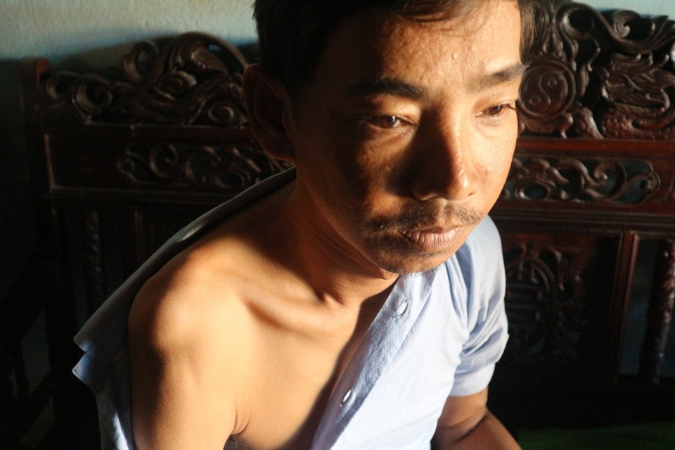 Bi kịch cả gia đình lao đao vì bệnh hiểm nghèo - 8 Đôi vai sưng tấy, cử động khó khăn, đến việc mặc áo hay tắm giặt đều phải nhờ tay vợ giúp đỡ
