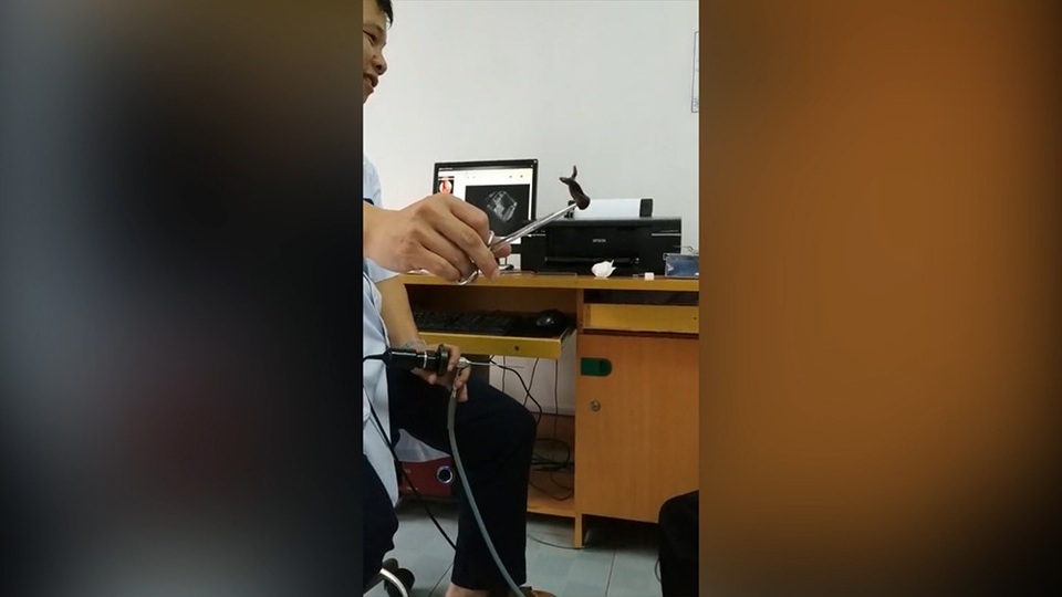 Rùng mình cảnh bác sĩ gắp “đỉa khủng” ra khỏi mũi bệnh nhân - 1 Con đỉa có kích thước khá lớn được gắp ra khỏi mũi một bệnh nhân khiến nhiều người rùng mình.