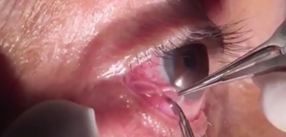 Một con giun chỉ xuất hiện trong lòng trắng mắt của một bệnh nhân tại Ấn Độ khiến nhiều người không khỏi rùng mình.