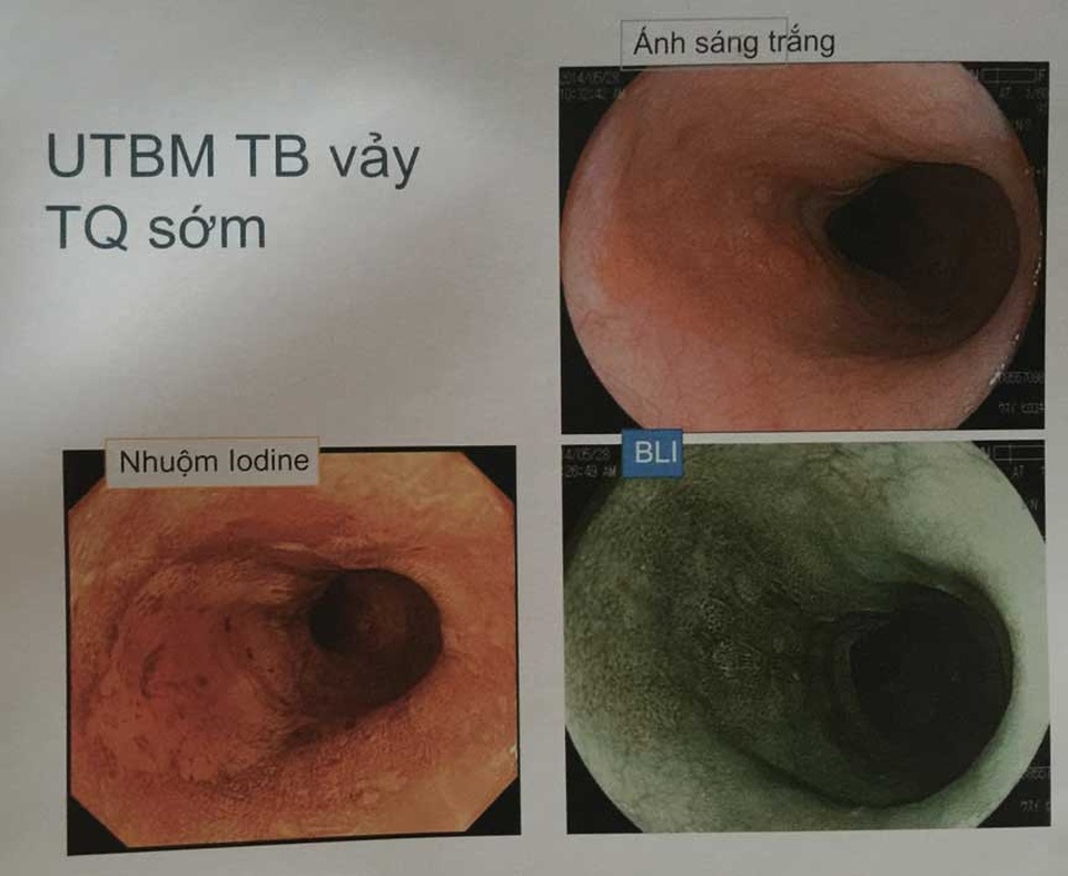 Ung thư thực quản: Có thể chẩn đoán sớm đến mức nào? - 2
Kỹ thuật ánh sáng BLI và nhuộm màu giúp phát hiện ung thư qua nội soi không cần sinh thiết