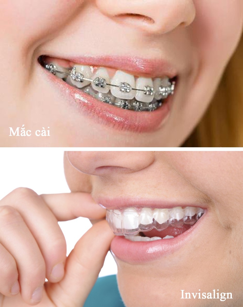 Công nghệ niềng răng Invisalign không gây mất tự tin - 1 Công nghệ niềng răng Invisalign (ảnh dưới) sẽ không gây mất tự tin.