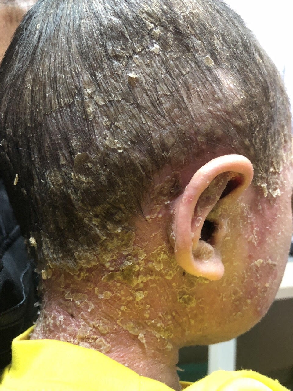 Cậu bé “người cóc” đau đớn vì sần sùi, bong vảy toàn thân - 1 Cậu bé “người cóc” đau đớn vì sần sùi, bong vảy toàn thân - 1