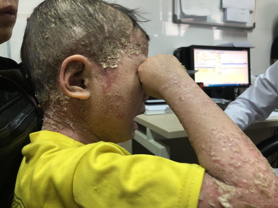 Cậu bé “người cóc” đau đớn vì sần sùi, bong vảy toàn thân - 3 Những mảng bong tróc toàn thân khiến bệnh nhi đau đớn.