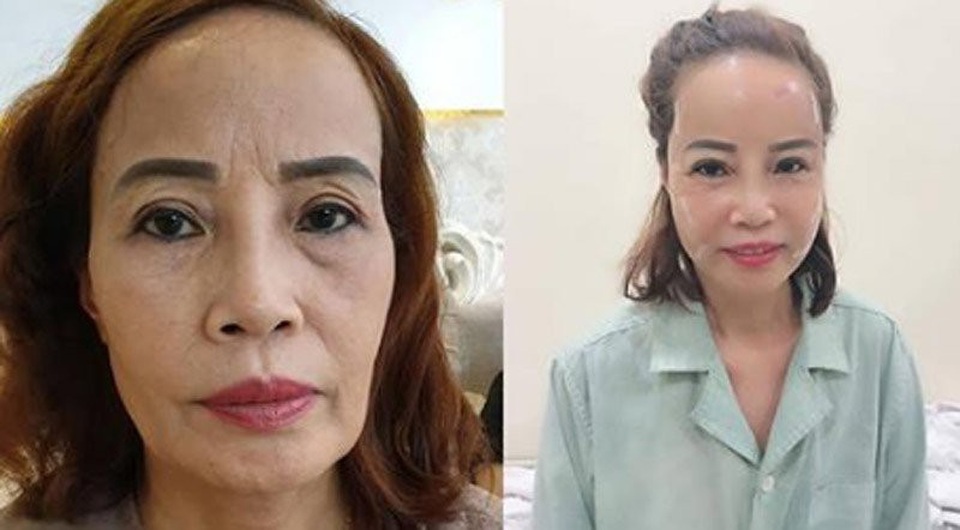 Cô dâu 62 tuổi đi làm tóc với khuôn mặt sưng phồng sau phẫu thuật - 2 Khuôn mặt khác lạ của cô dâu 62 tuổi sau khi tân trang nhan sắc