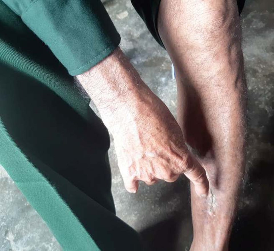 Xót thương cuộc sống khốn cùng của gia đình cựu tù Côn Đảo - 2 Đã nhiều năm nay, vết thương bom đạn vẫn luôn hành hạ cơ thể ông.