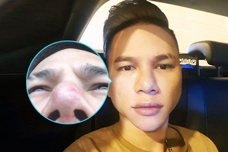 Mũi Hoàng Tôn bị sưng to và lâu, đầu mũi thì bị đỏ lên, nổi mạch máu... Về cằm thì cũng sưng rất to. Vì gương mặt “dao kéo” hỏng nên Hoàng Tôn quyết định công khai và nhờ cư dân mạng chia sẻ bí quyết chỉnh sửa cứu gương mặt một lần nữa.