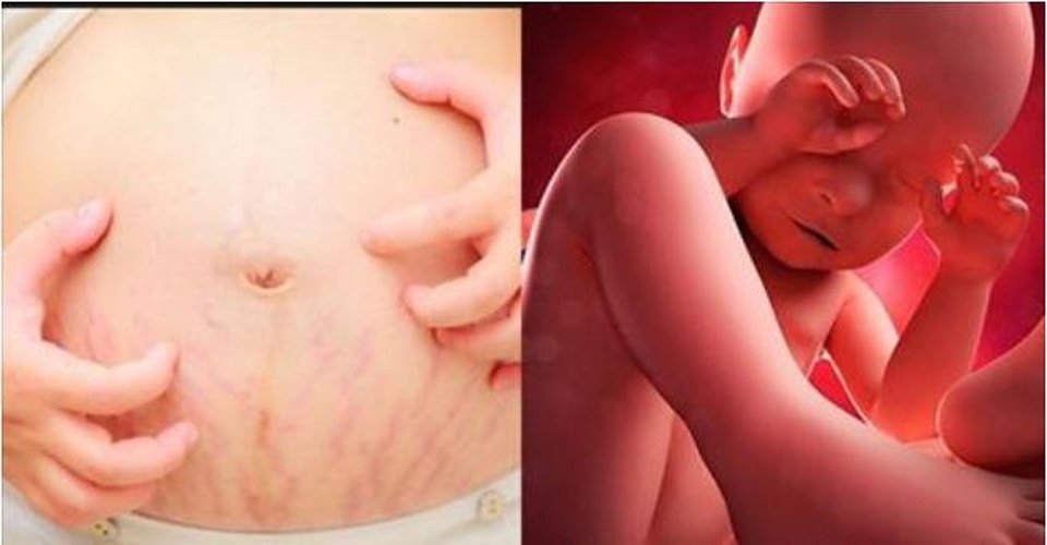 Tiểu đường thai kỳ - đừng chủ quan! - 4 Tiểu đường thai kỳ - dấu hiệu nhỏ, bệnh lý lớn
