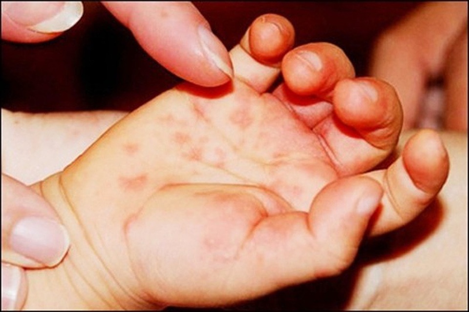 Nhiều ca diễn biến nặng, vi rút tay chân miệng có biến chủng? - 2 Nhiều ca diễn biến nặng, vi rút tay chân miệng có biến chủng? - 2