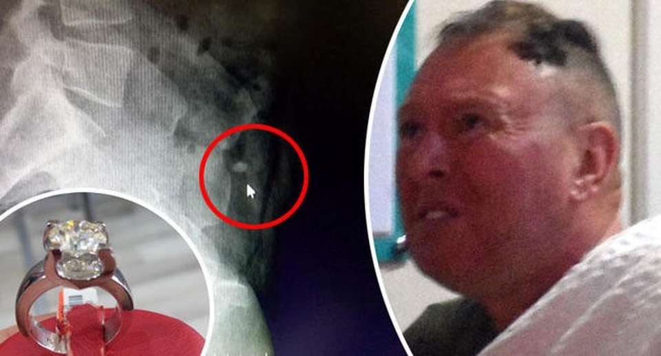 Du khách nuốt vội nhẫn kim cương gần 1 tỷ đồng hòng để phi tang - 1 Kết quả chụp X quang cho thấy chiếc nhẫn kim cương nằm trong dạ dày của vị khách