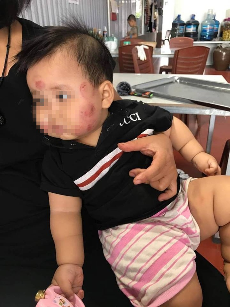 Bắc Giang: Bé 12 tháng bầm tím khắp người sau khi gửi trẻ - 1 Cháu bé với nhiều vết bầm tím trên mặt sau khi gửi trẻ (Ảnh: fb gia đình).