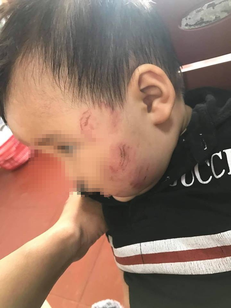 Bắc Giang: Bé 12 tháng bầm tím khắp người sau khi gửi trẻ - 3 Chị Huệ rất xót xa khi nhìn khuôn mặt con với nhiều vết bầm tím sau khi từ lớp về.