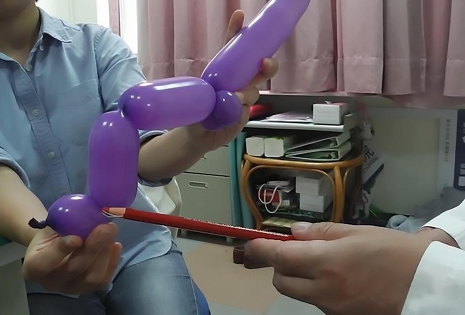 “Của quý” gãy làm 3 do sai tư thế khi “yêu” - 2 Các bác sĩ dùng một quả bóng để mô tả chính xác những gì đã xảy ra