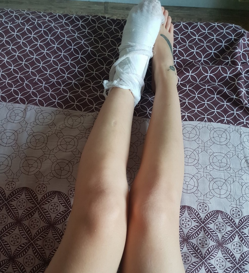 Hình ảnh một bên chân phải băng bó được cô gái chia sẻ lên mạng xã hội