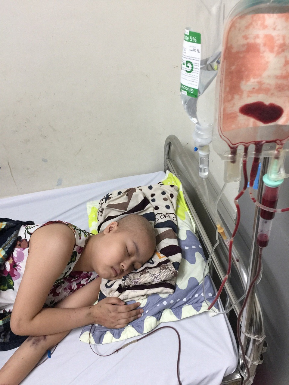 Tình cảnh đáng thương của cô bé dân tộc Sán Dìu bị ung thư máu - 2 Hương Giang của hiện tại đang phải chống chọi với căn bệnh ung thư máu.