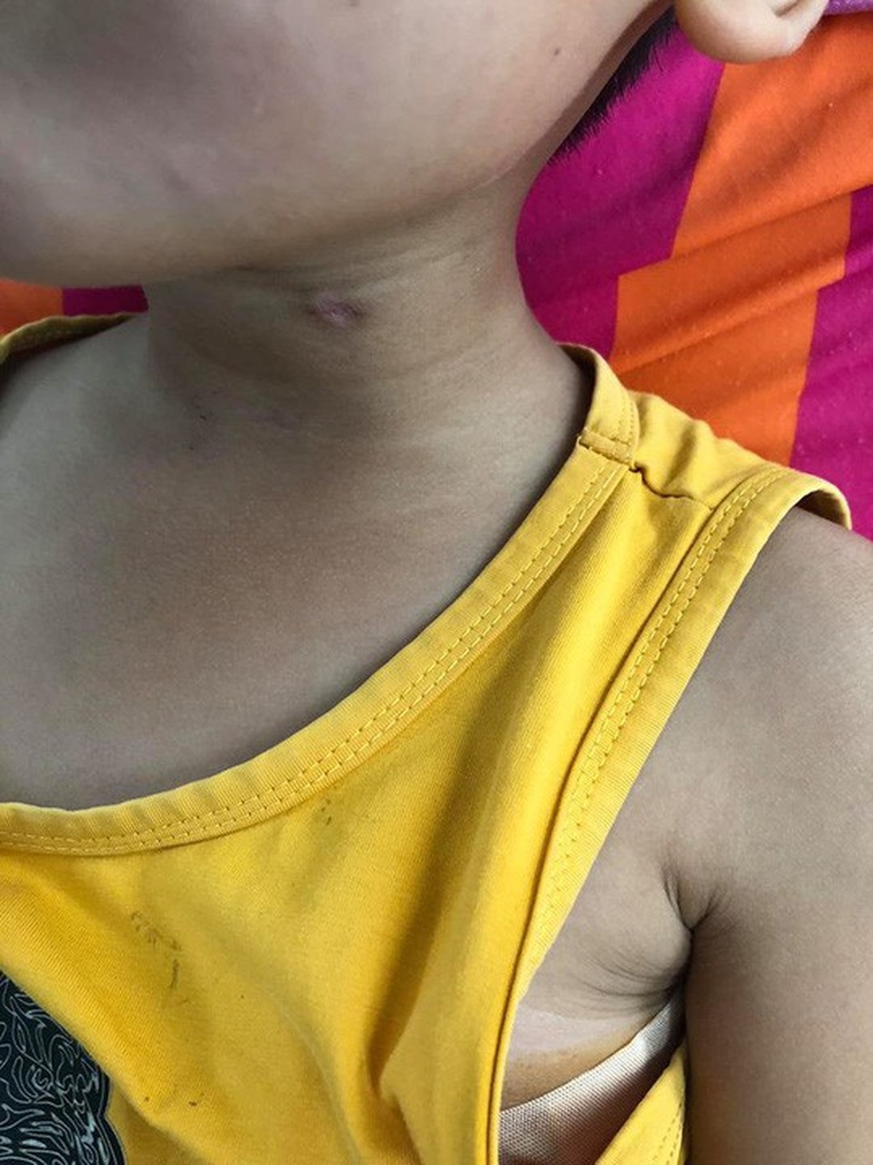 Vết sẹo do bị đạn bắn ở cổ bé M.H. Ảnh do bệnh viện cung cấp