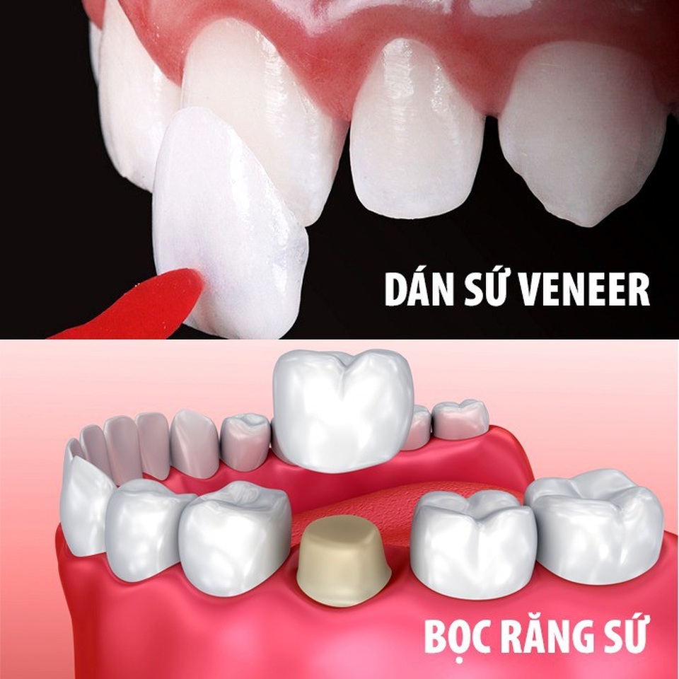Những hiểu lầm về bọc răng sứ - 1 Những hiểu lầm về bọc răng sứ - 1