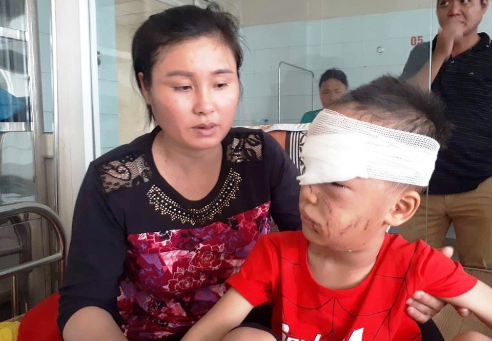 Kinh hoàng bé trai 6 tuổi bị chó nhà cắn rách mặt - 1 Cháu Đồng đang được điều trị tại Bệnh viện Nhi Thanh Hóa.